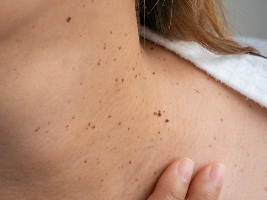 Skin Lesion Treatment (Face or Neck)