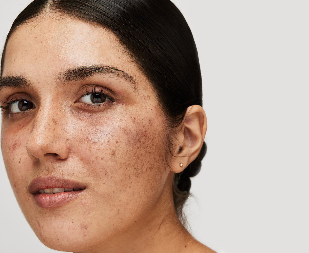 Melasma Requires Strategy, Patience and Ongoing Protection.