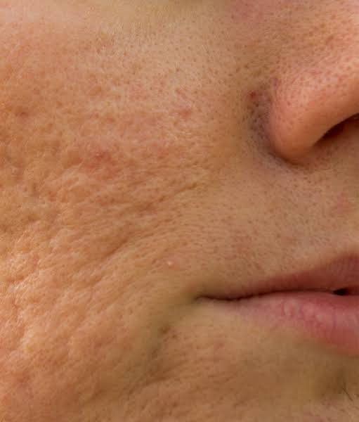 Acne Scars Require More Than One Treatment—and More Than One Tool.